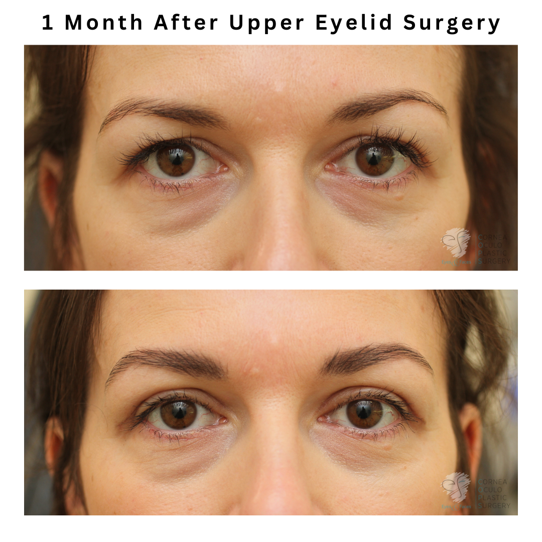 Before and after blepharoplasty (upper eyelid surgery) by Dr Anthony Maloof in Sydney.