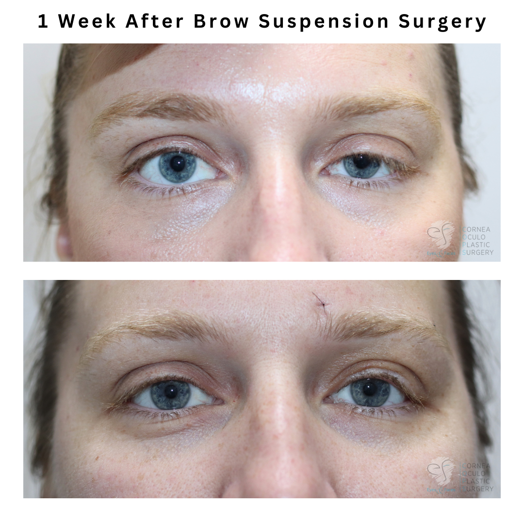 1 week after brow suspension surgery performed by Dr Anthony Maloof in Sydney