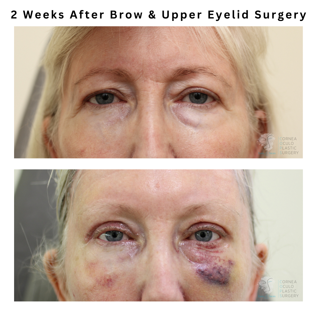 Brow and upper eyelid surgery performed by Dr Anthony Maloof in Sydney