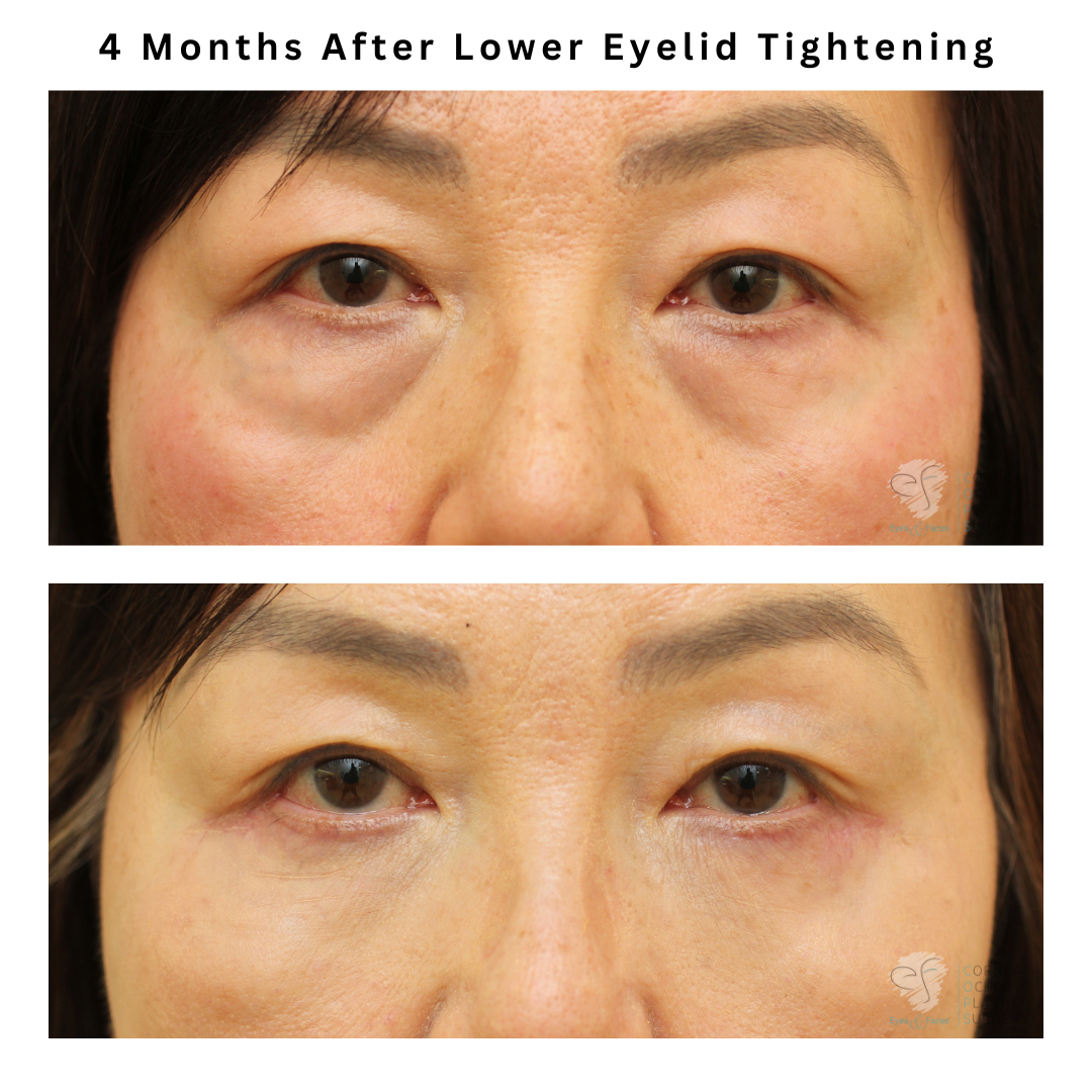 Before and after of lower eyelid tightening by Dr Anthony Maloof in Sydney.