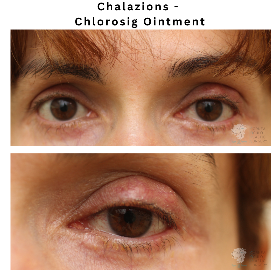 Chalazions - Chlorosig Ointment - Dr Anthony Maloof 